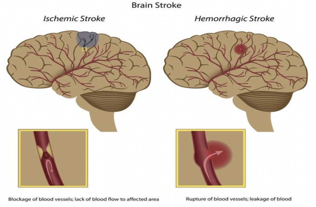 Graphic showing two types of strokes