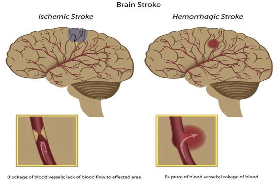 Graphic showing two types of strokes