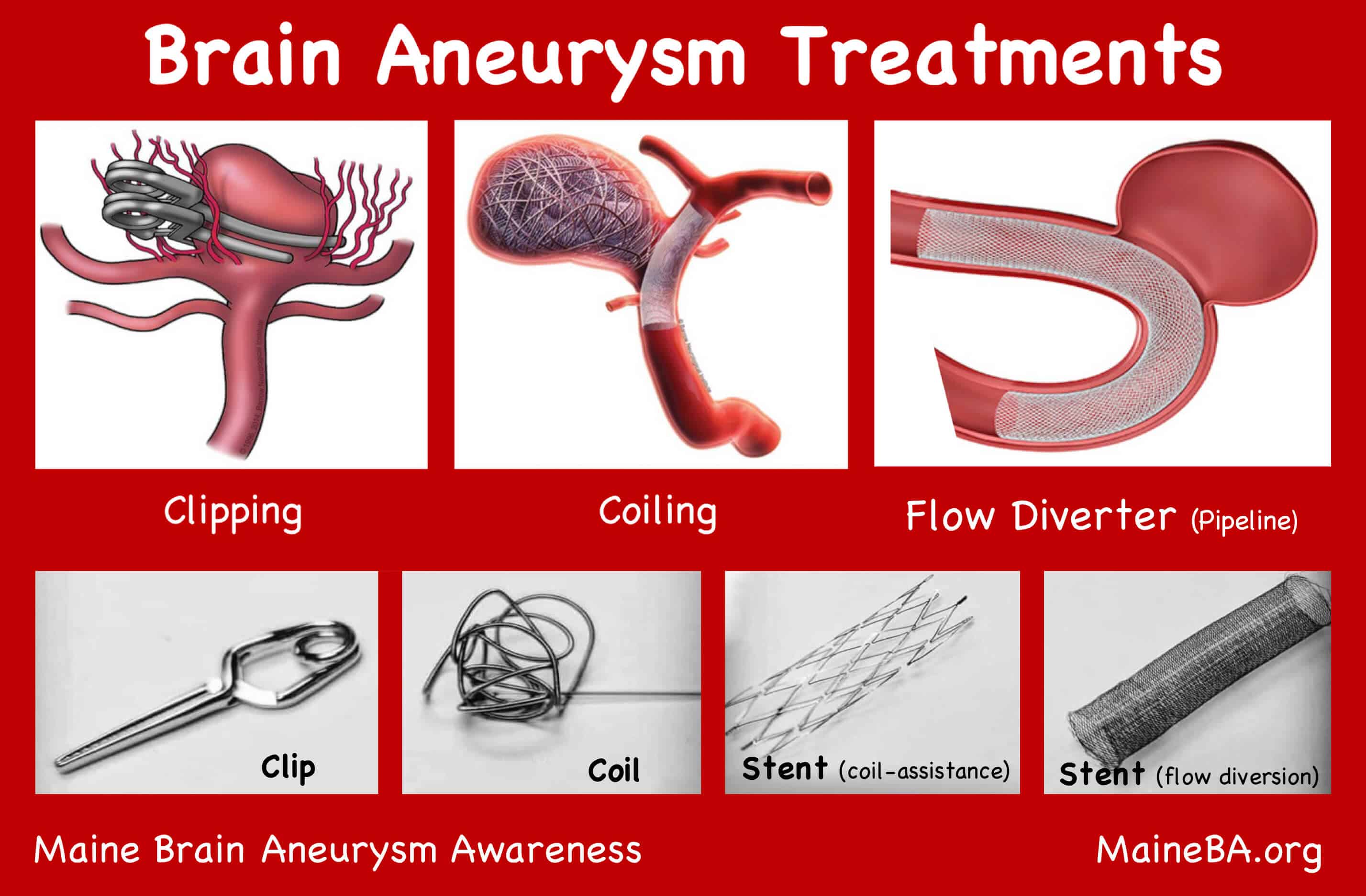 Graphic showing four brain aneurysm treatment options