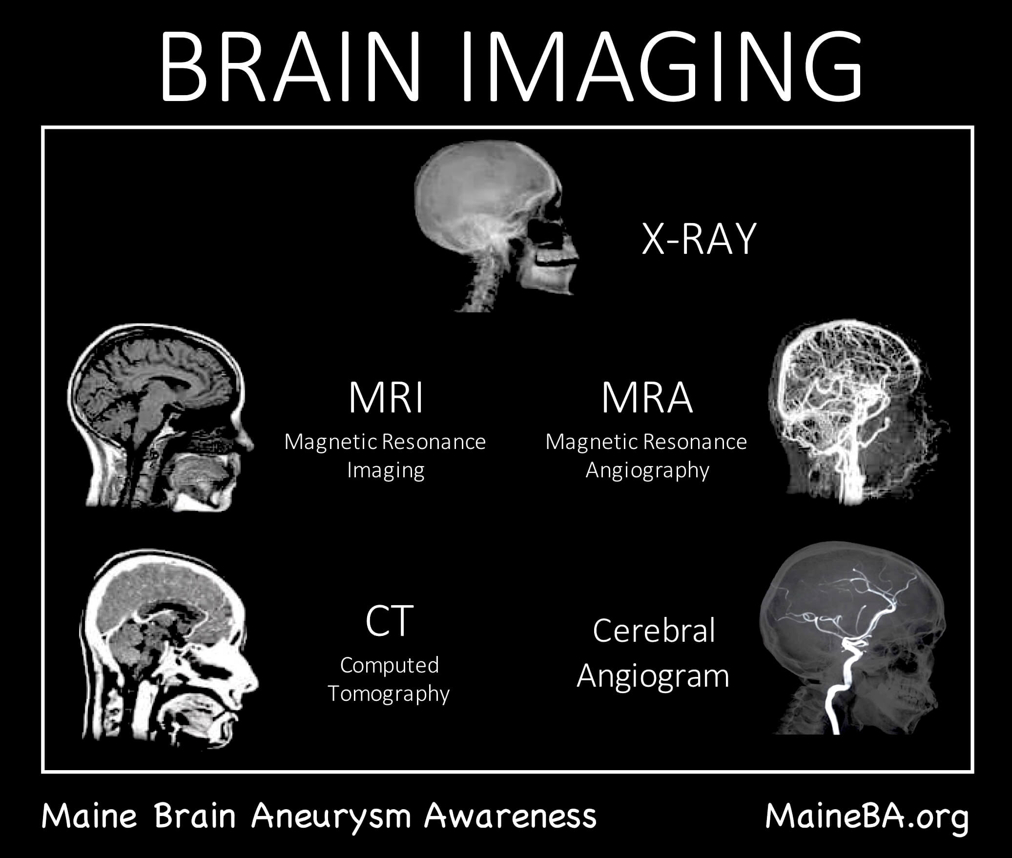 Graphic showing types of brain aneurysm diagnosis options