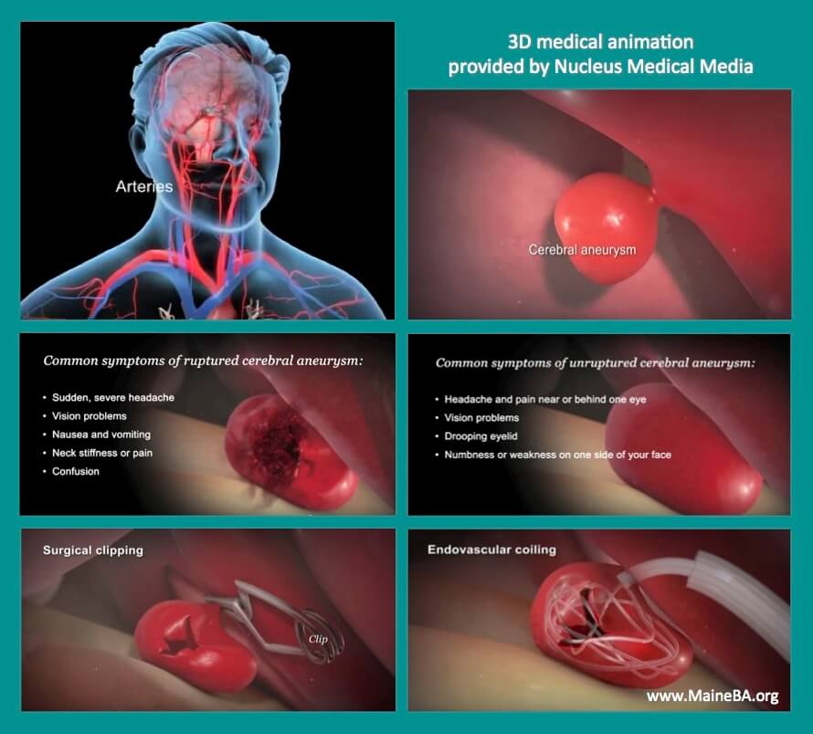 Screen shots of 3D animation for brain aneurysms