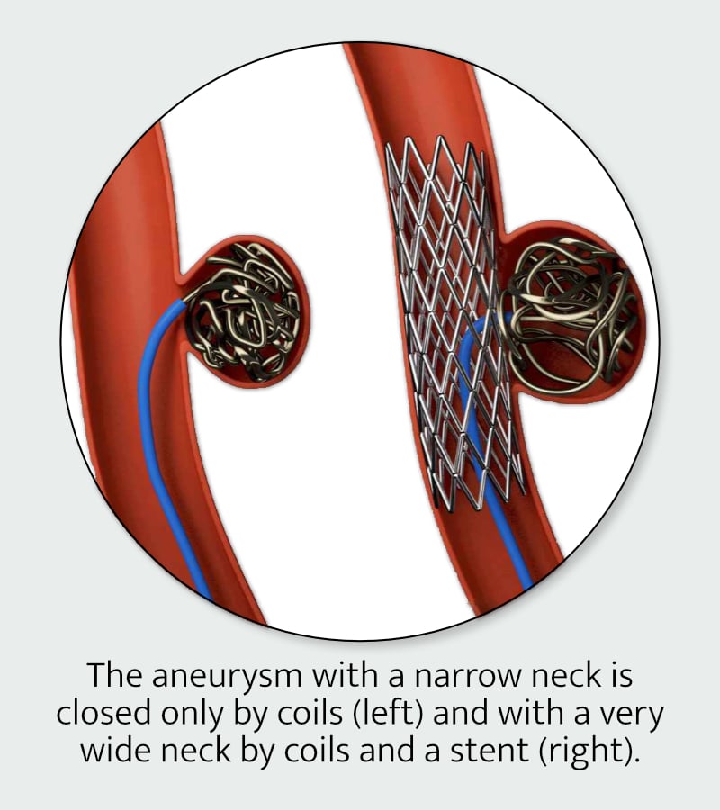 Side by side graphics of artery with coils