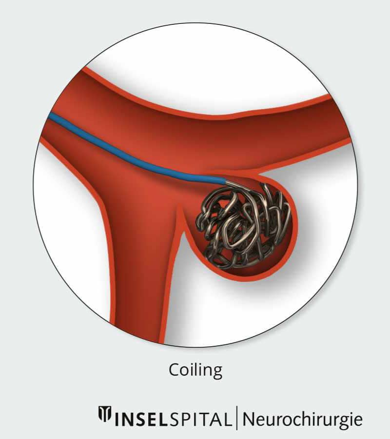 Illustration showing coiling inside brain aneurysm