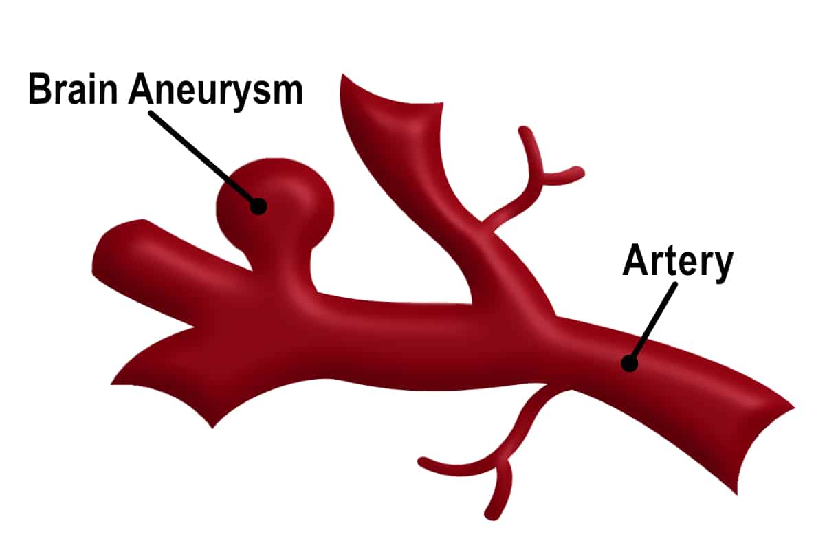 About Brain Aneurysms – Maine Brain Aneurysm Awareness