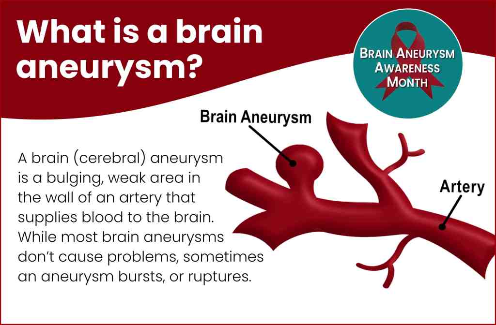 What is a brain aneurysm graphic