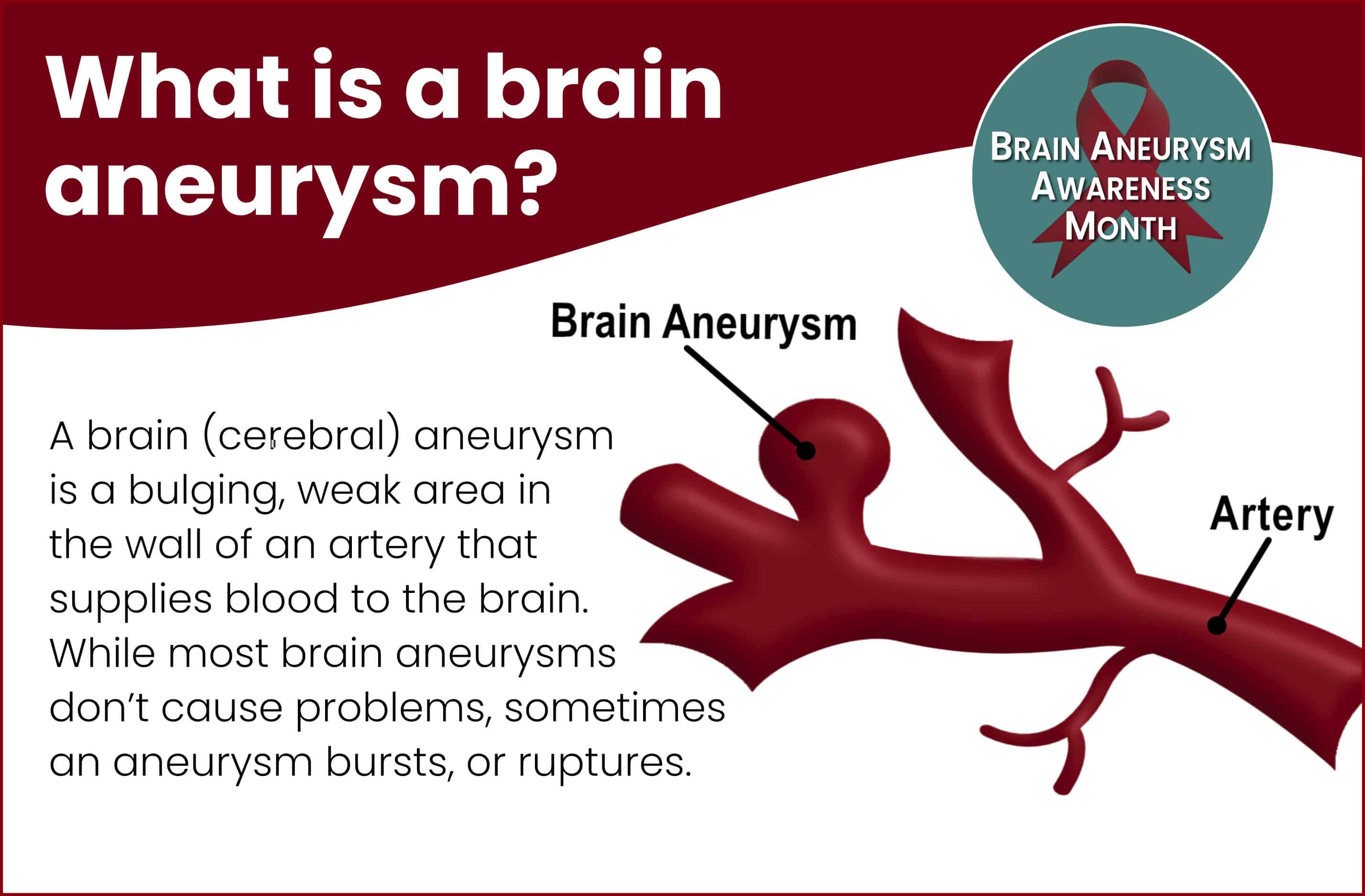 What Is a Brain Aneurysm?