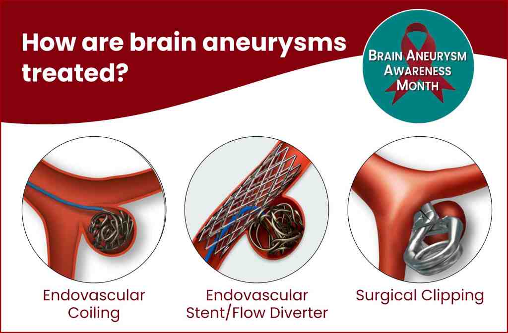 brain aneurysm treatments graphic