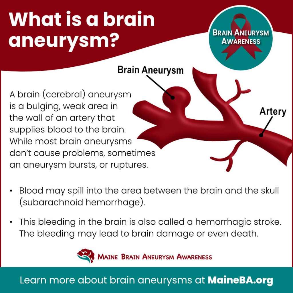 What is brain aneurysm graphic